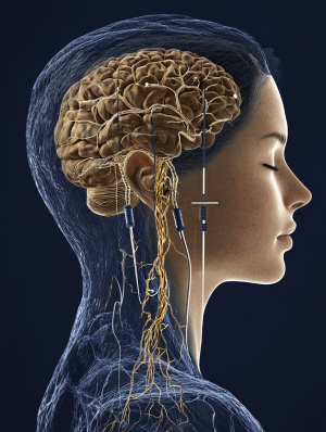 Vagus Nerve Stimulation